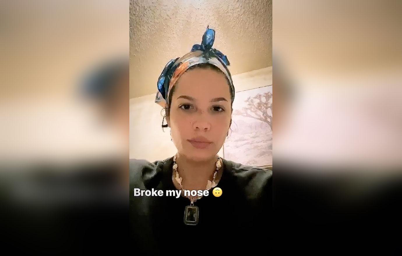 Halsey With A Broken Nose