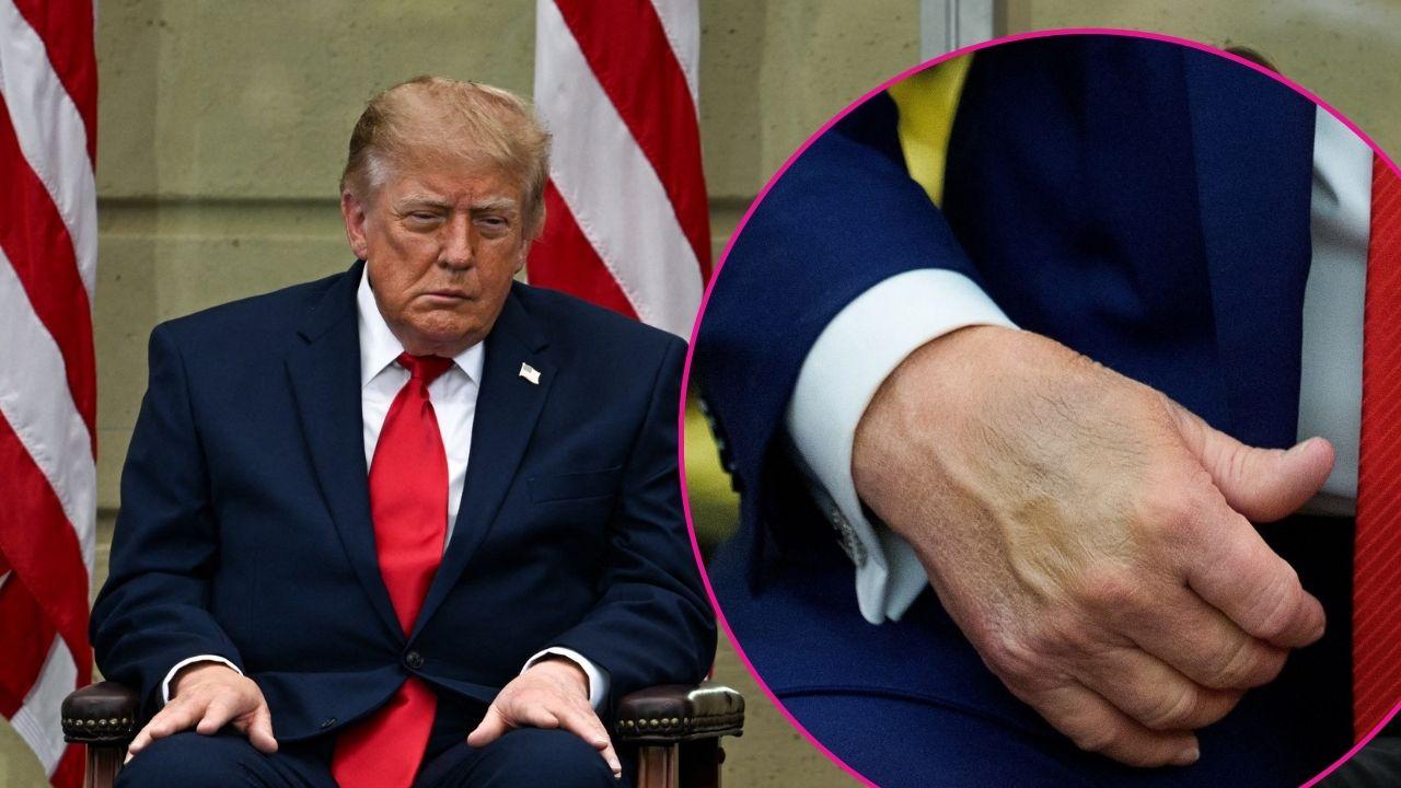 Composite photo of Donald Trump and his bruised hands.