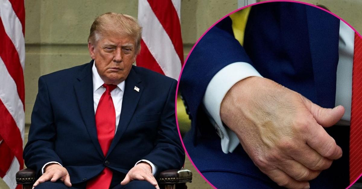 Donald Trump's Bruised Hands and Tired 9/11 Appearance Put His Health Back in the Spotlight