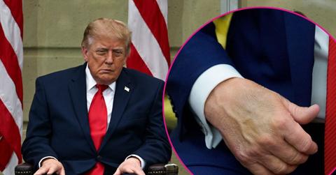 Composite photo of Donald Trump and his bruised hands.