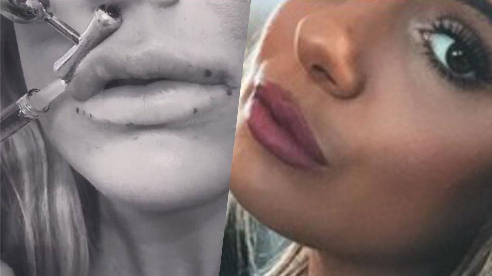 Brielle biermann zolciak lip injections