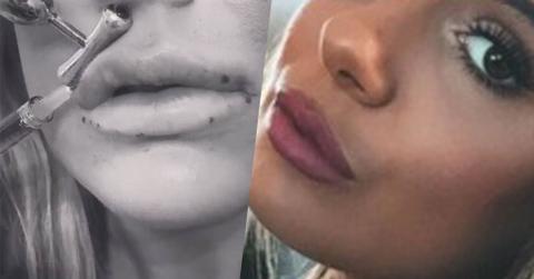 Brielle biermann zolciak lip injections