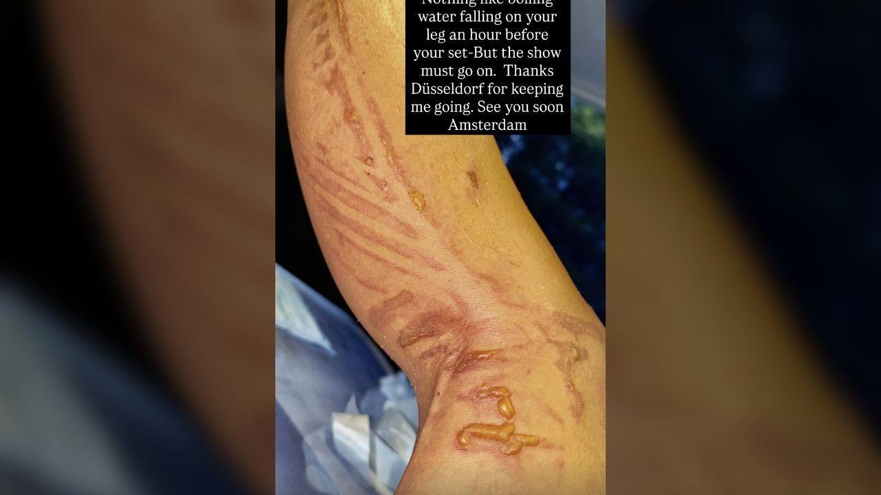 image of Nicole showed the injury on social media.