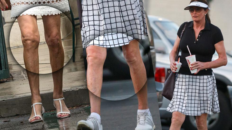 caitlyn jenner surgery knee lift legs