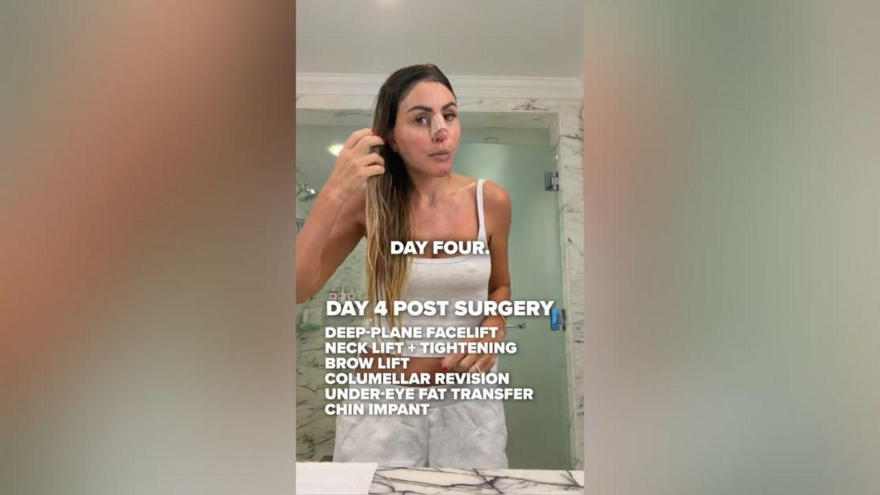 rachel uchitel dramatic facelift transformation before after photos