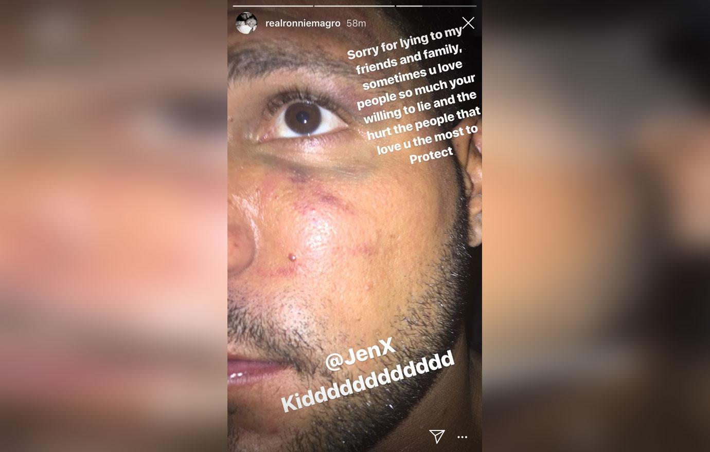 Ronnie ortiz magro black eye pic blames baby mama jen harley 01