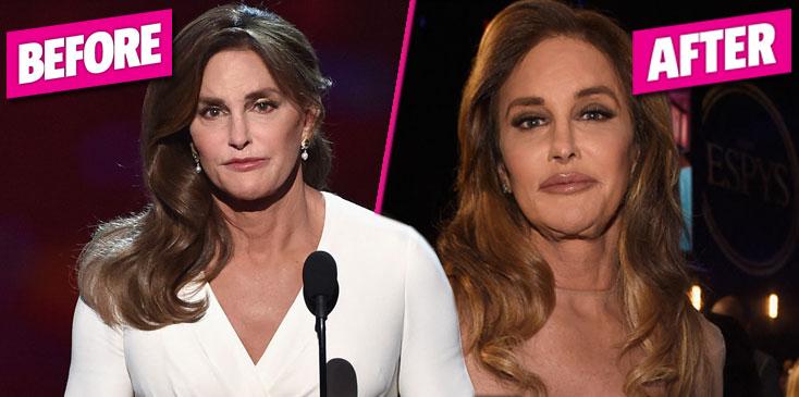 Plastic Not Fantastic Caitlyn Jenner’s Shocking Face At