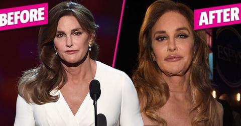 Caitly jenner plastic surgery espys HERO