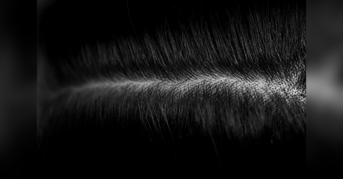 top  hair transplant clinics in turkey