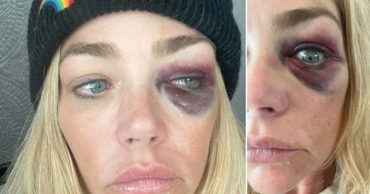 image of Denise Richards shared eye injury photos in a domestic violence restraining order filing against Aaron Phypers.