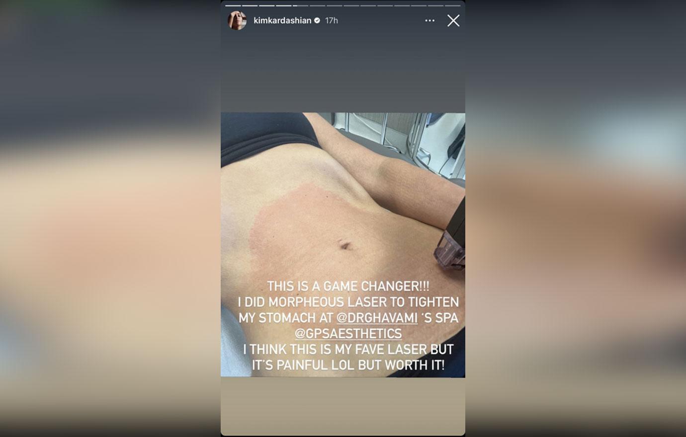 Kim Kardashian Under Fire For Getting 'Painful' Tightening Procedure