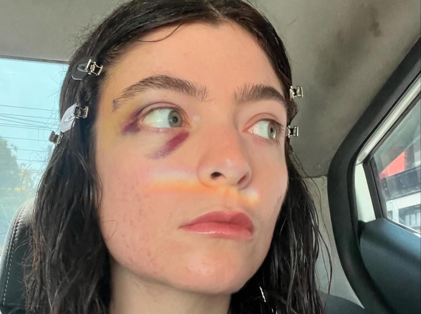 lorde worries fans photos bruised black eye deleting instagram posts