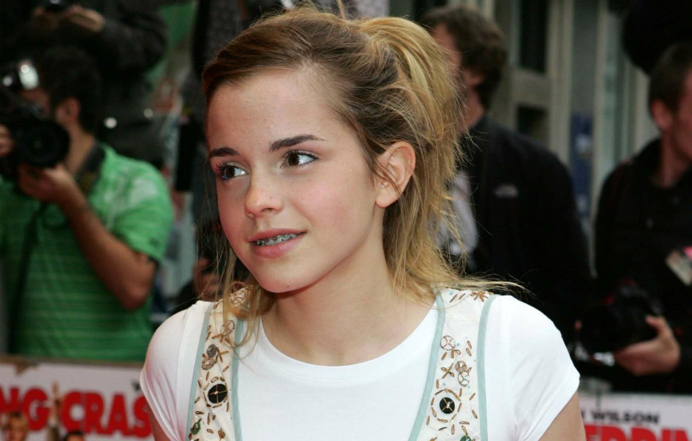 emma watson before and after braces