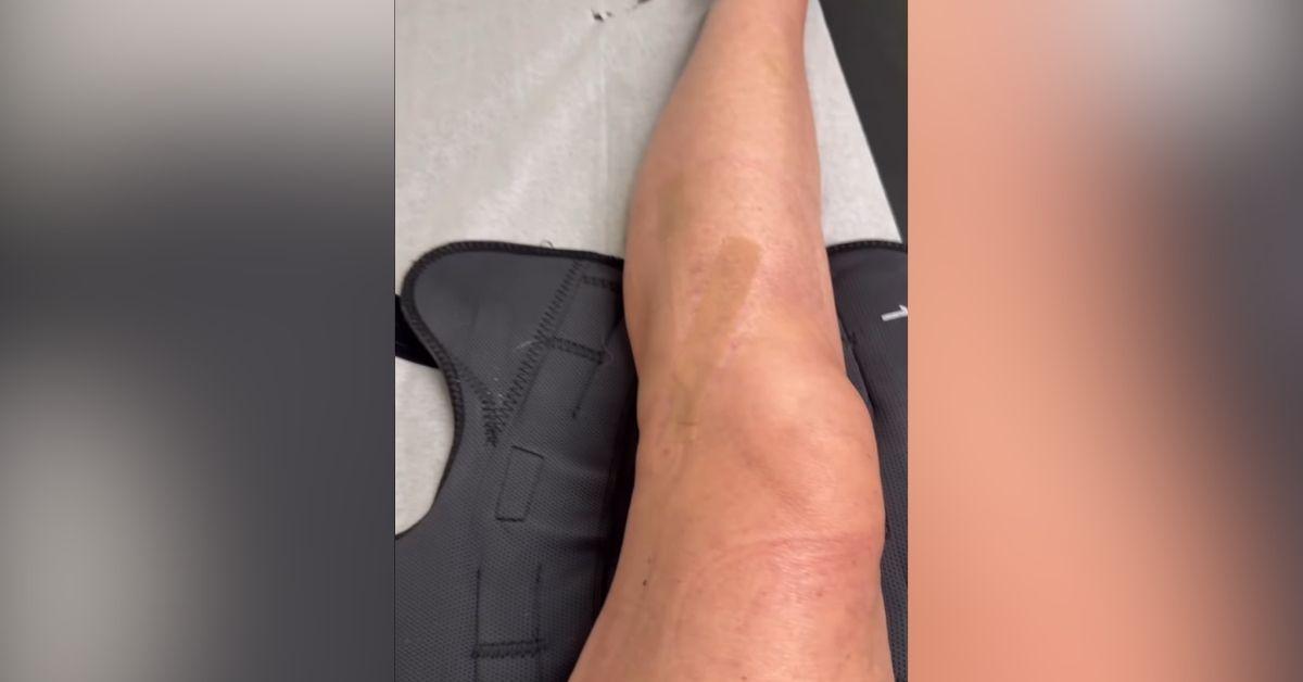 image of Kate Gosselin uses crutches and a metal bar during physical therapy sessions.