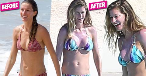 Gisele bundchen bikini plastic surgery 03