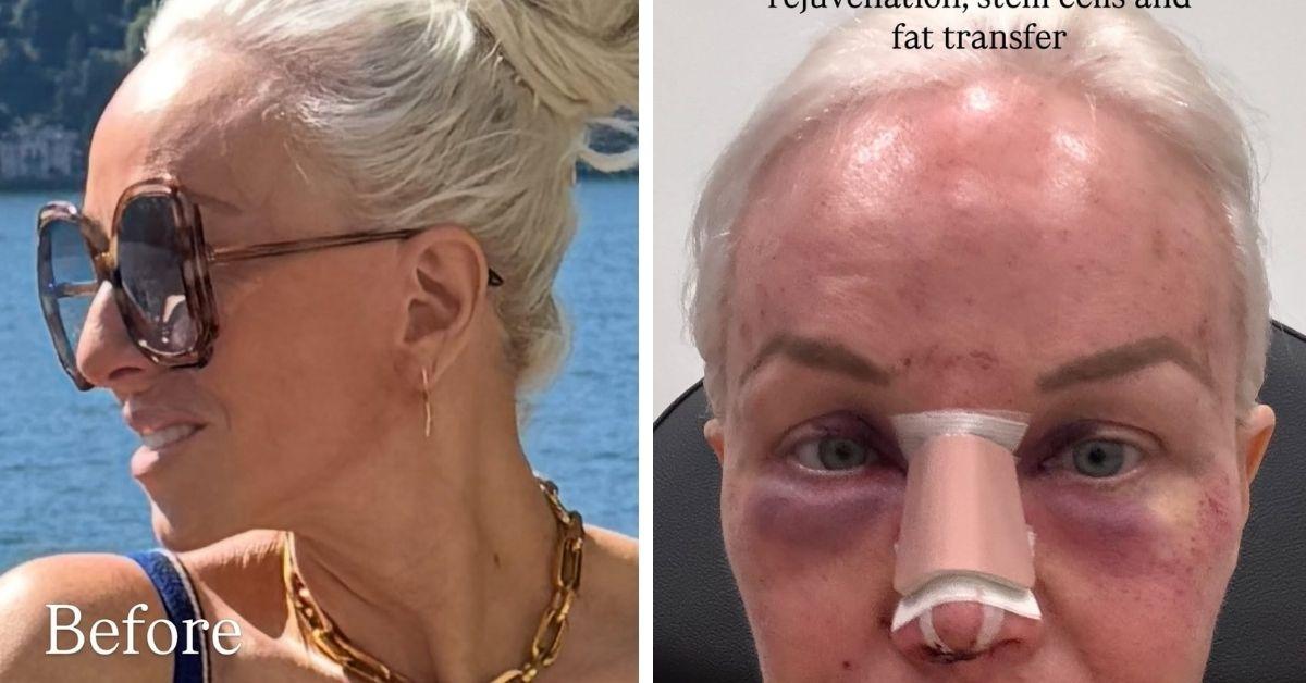 image of Margaret Josephs fixed her droopy nose tip.