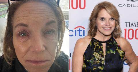 katie couric shows eczema flare up makeup free face picture