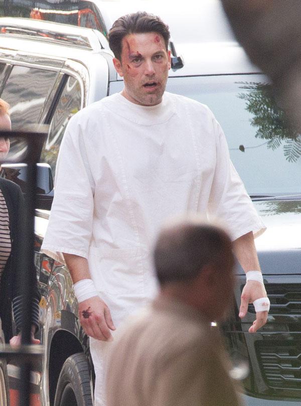 Ben Affleck Plastic Surgery Bruises