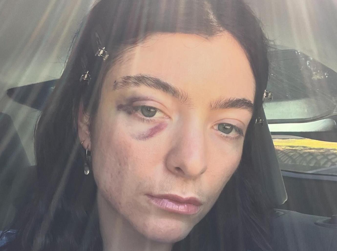 lorde worries fans photos bruised black eye deleting instagram posts