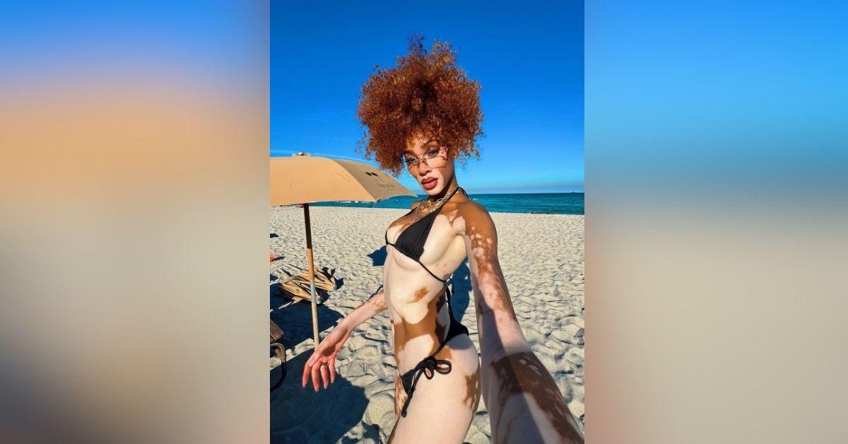 winnie harlow vitiligo confidence