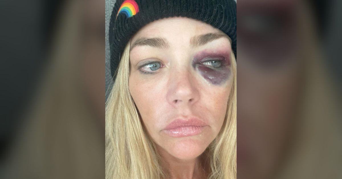 Image of Denise Richards alleged Aaron Phypers gave her a black eye.