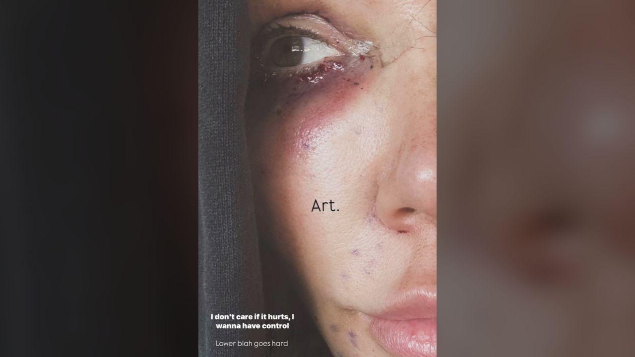 Photo of Bunnie Xo called her bruising 'art.'