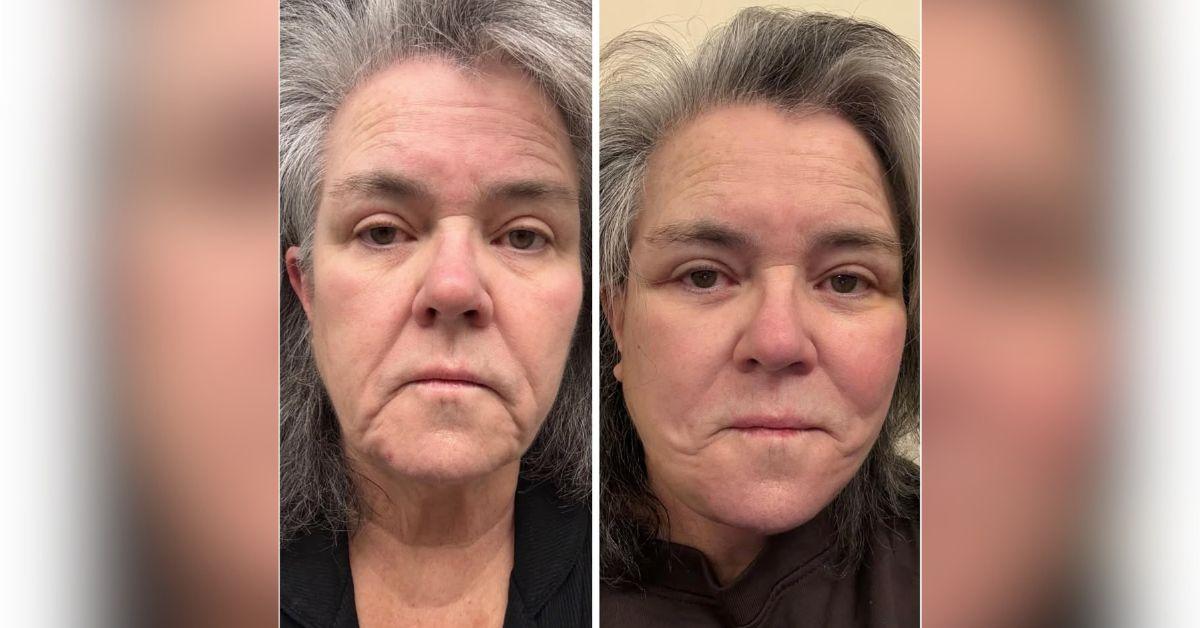 image of Rosie O'Donnell revealed she underwent a facelift earlier this year.